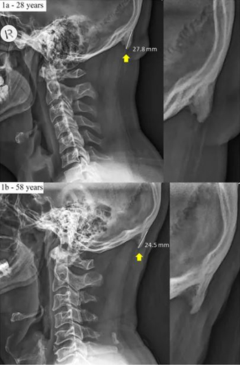 28세 청년의 두개골 엑스레이(위)와 58세 중년의 엑스레이(아래), 위는 튀어나온 부분이 2.78㎝인 데 반해 아래는 2.45㎝로 더 짧다.